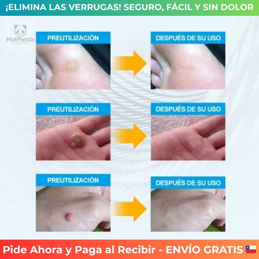 SKIN PRO FIX™ - 144 Parches Elimina Verrugas y Lunares- SIN DOLOR Ni Complicaciones