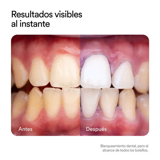 OBSESSIVE™ CORRECTOR DE COLOR V34 Dientes Blancos en Minutos