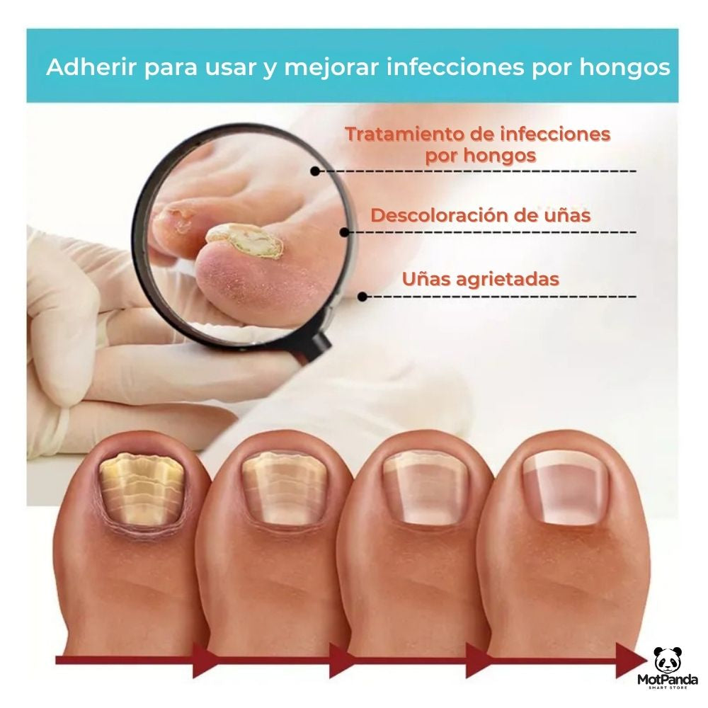 FungaClear™  PARCHES ANTIHONGO para Uñas