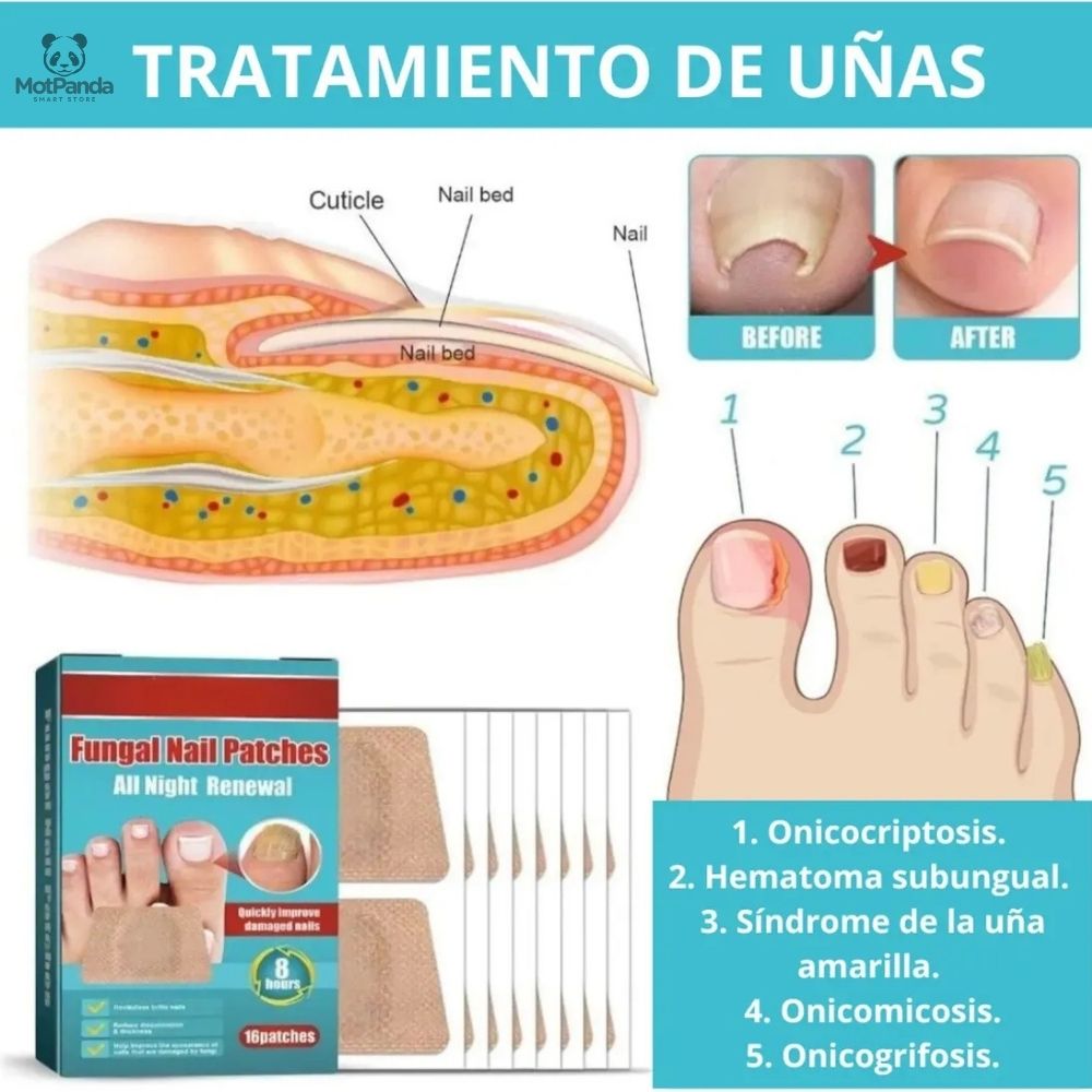 FungaClear™  PARCHES ANTIHONGO para Uñas
