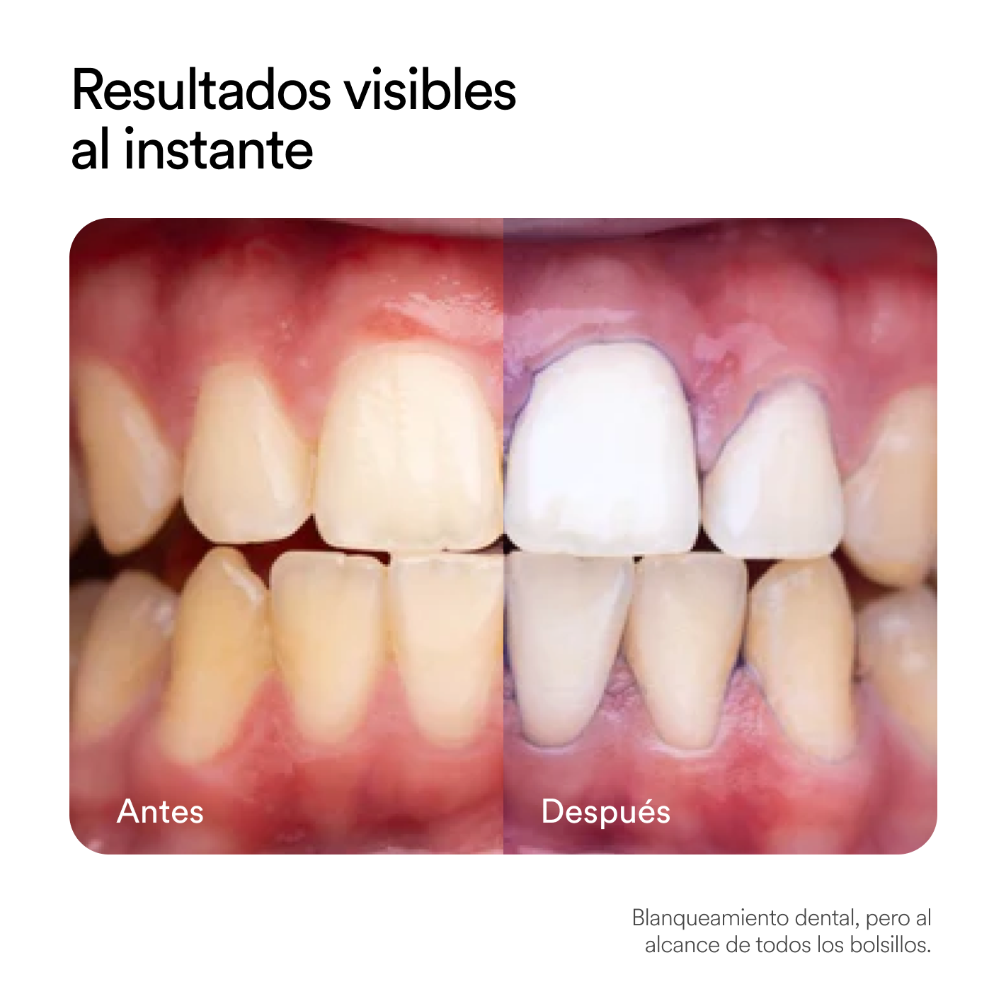 OBSESSIVE™ CORRECTOR DE COLOR V34 Dientes Blancos en Minutos